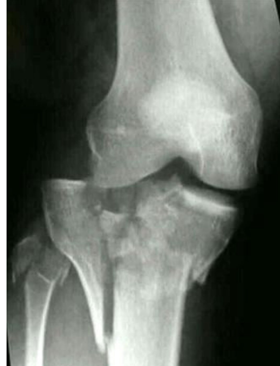 AP right knee X-ray after pedestrian collision.