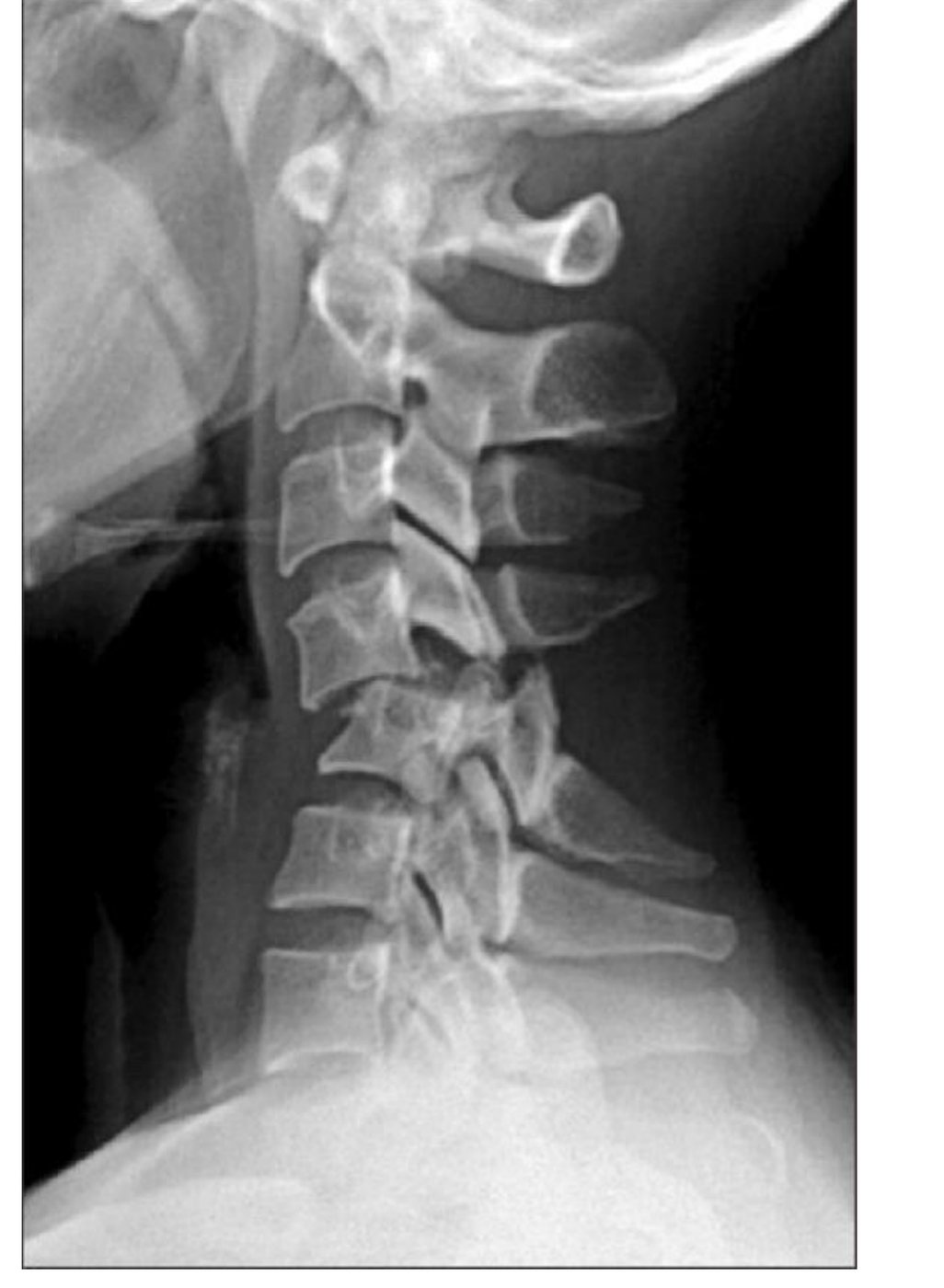 Lateral cervical spine X-ray after diving injury.