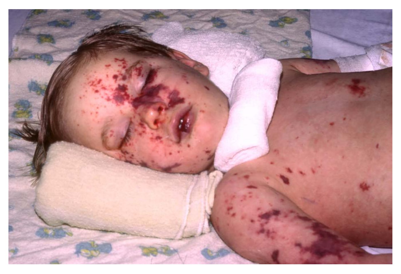 Clinical photograph of a rash in an unwell child.