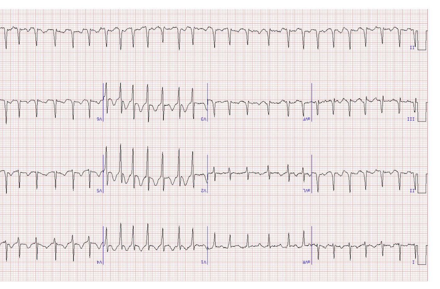 ECG for the palpitations presentation.