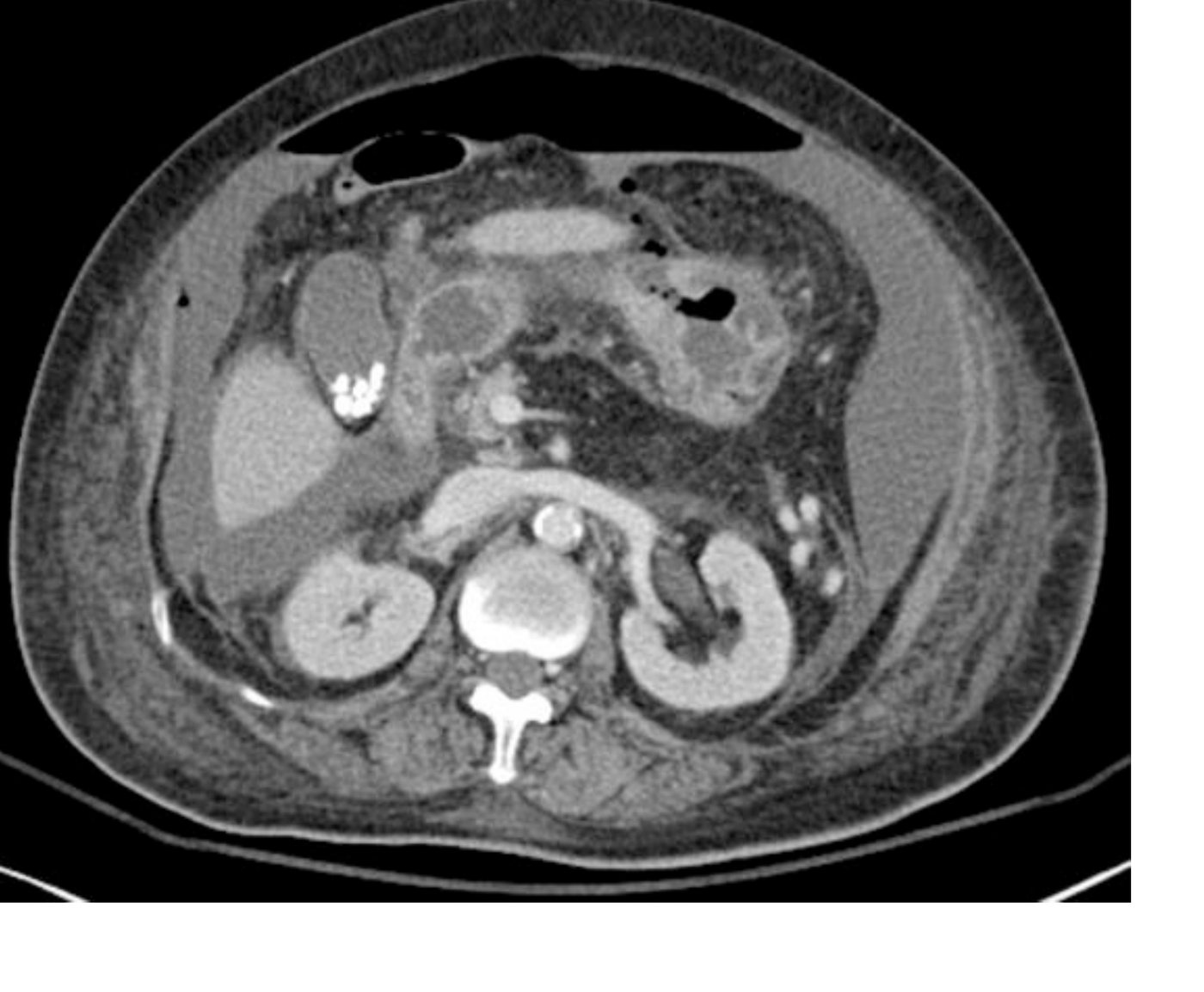 Axial CT abdomen for severe generalised abdominal pain.