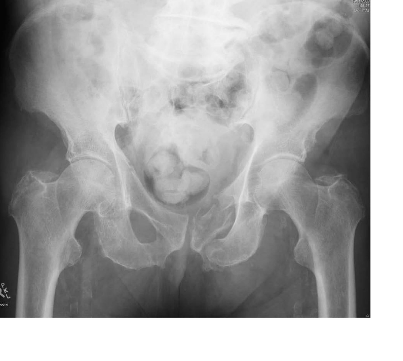 Pelvic X-ray after a fall with pelvic pain.