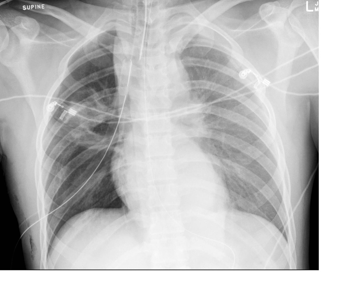 Supine chest X-ray after major chest trauma.