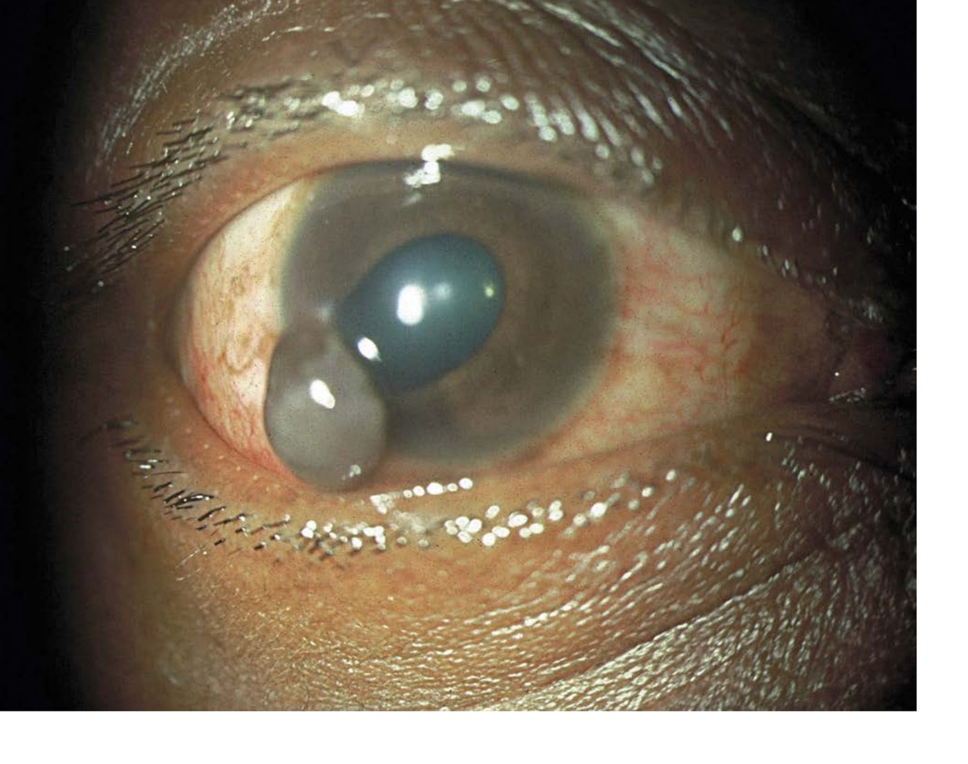 Clinical photograph of the right eye after hammering metal.