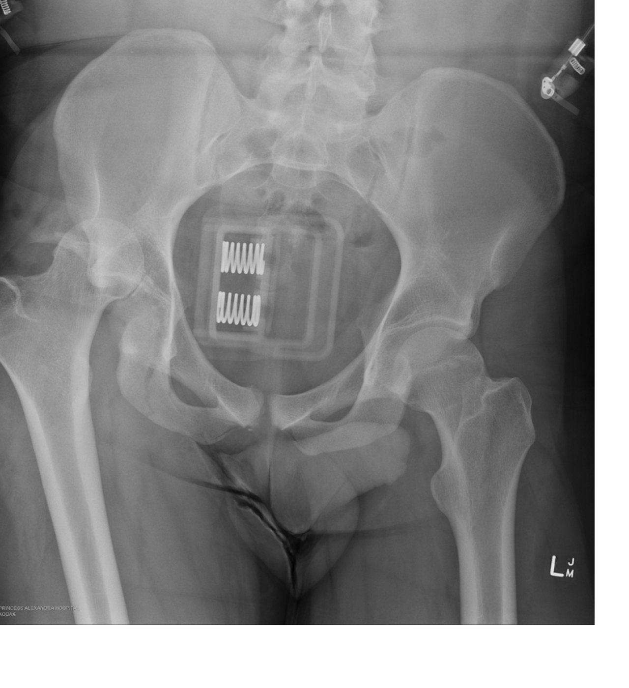 Pelvic X-ray after a fall onto the knee with right hip pain.