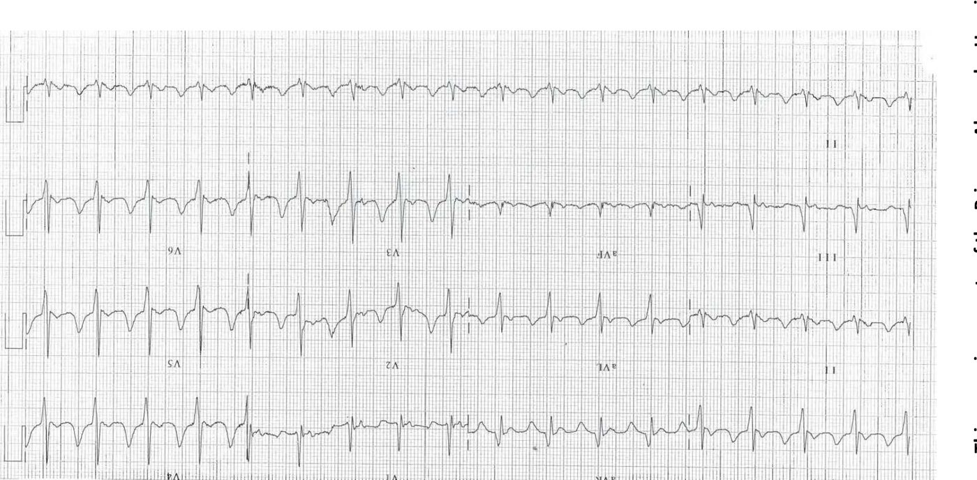 ECG after return of spontaneous circulation following PEA arrest.