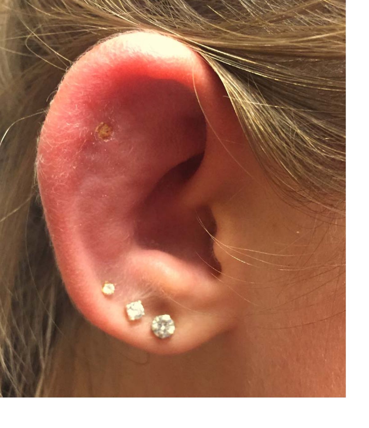 Clinical photograph of the right ear after cartilage piercing.