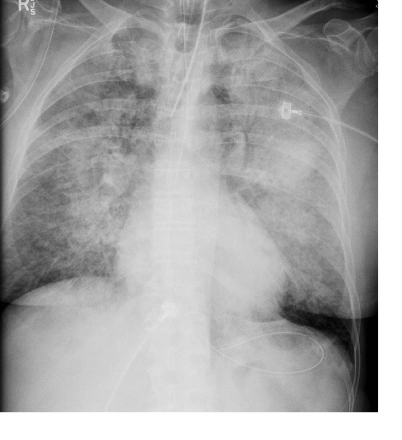 Chest X-ray after intubation in a collapse case.