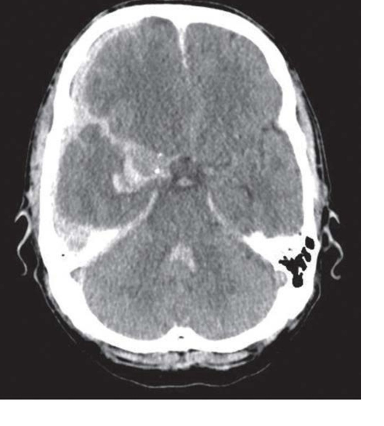 CT brain slice for a collapse with severe headache case.