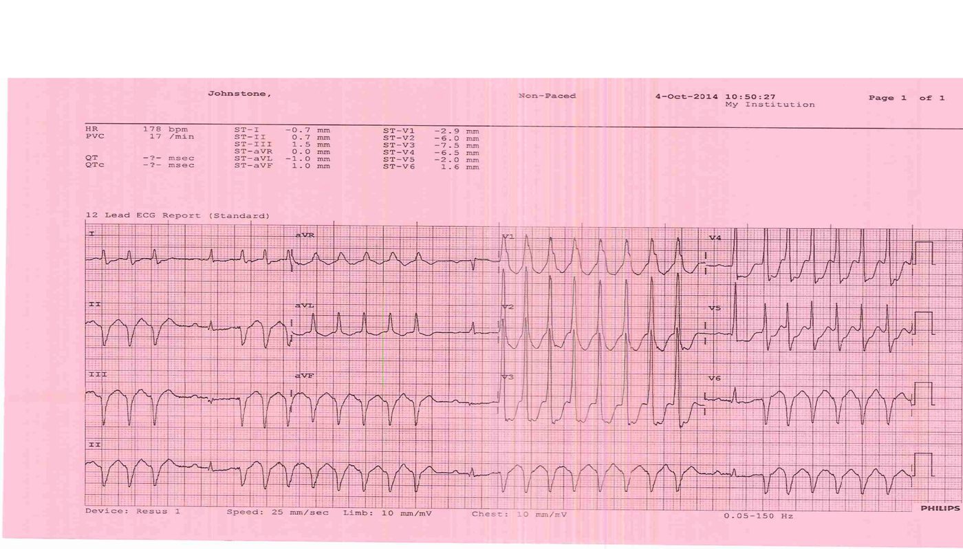 ECG for a patient with chest pain, dizziness and hypotension.