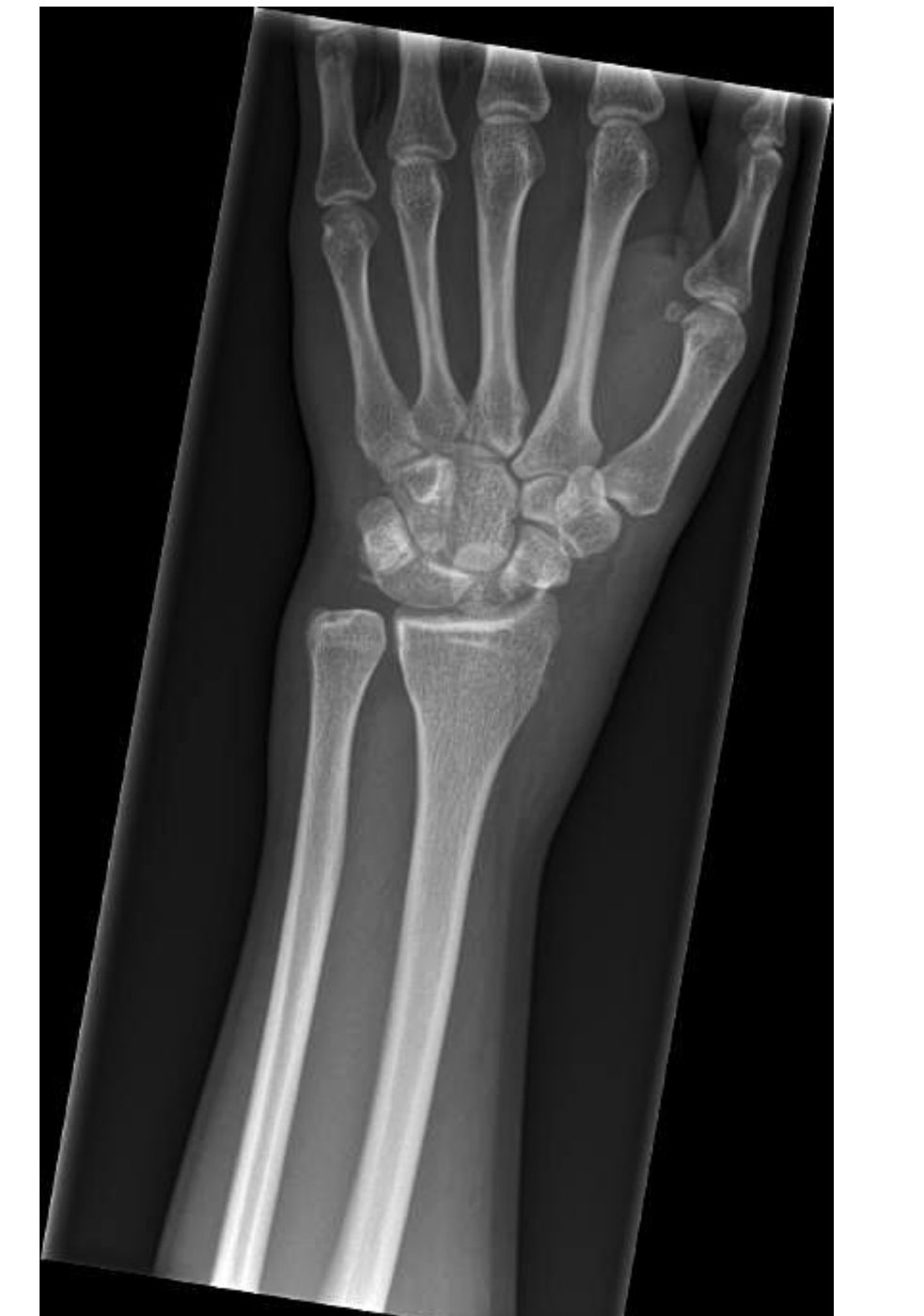 AP wrist X-ray after fall onto an outstretched hand.