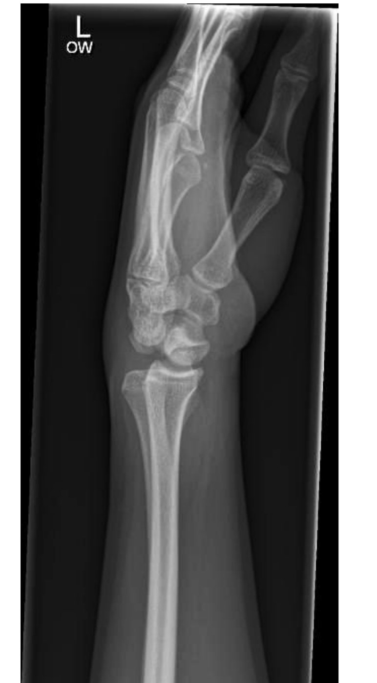 Lateral wrist X-ray after fall onto an outstretched hand.