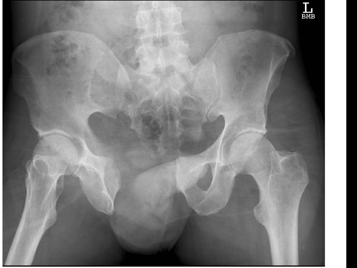 Pelvic X-ray for a motorcycle crash patient.