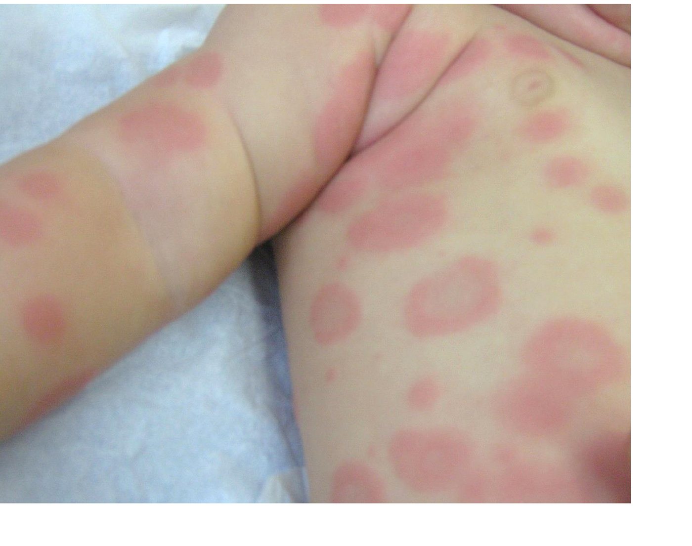 Clinical photograph of a rash in a febrile child.