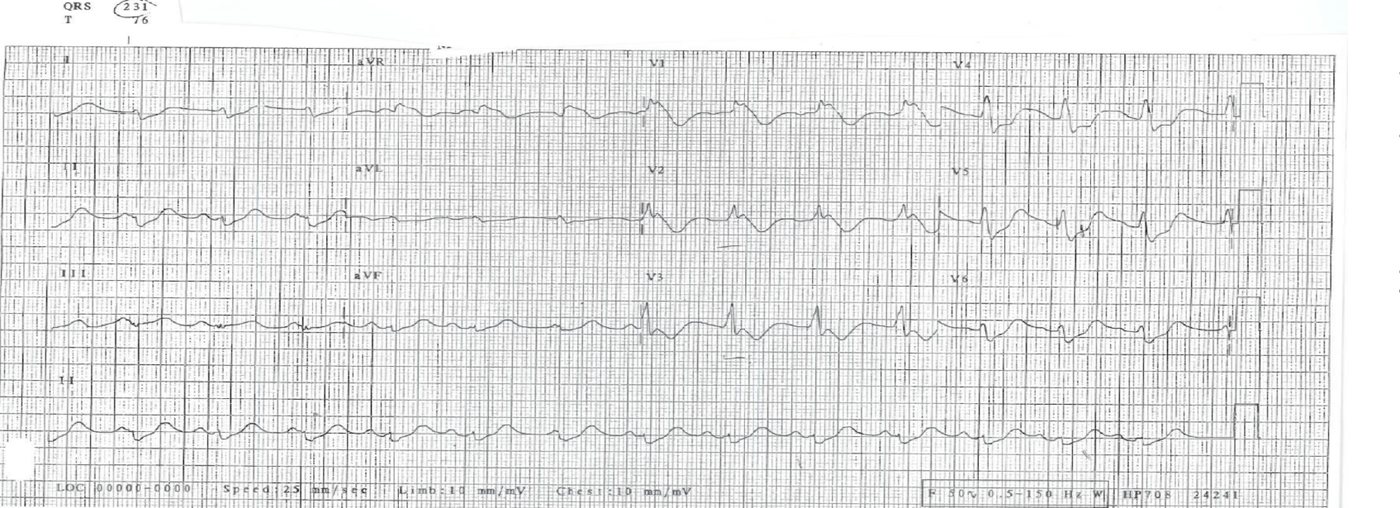 ECG for an unconscious overdose patient.