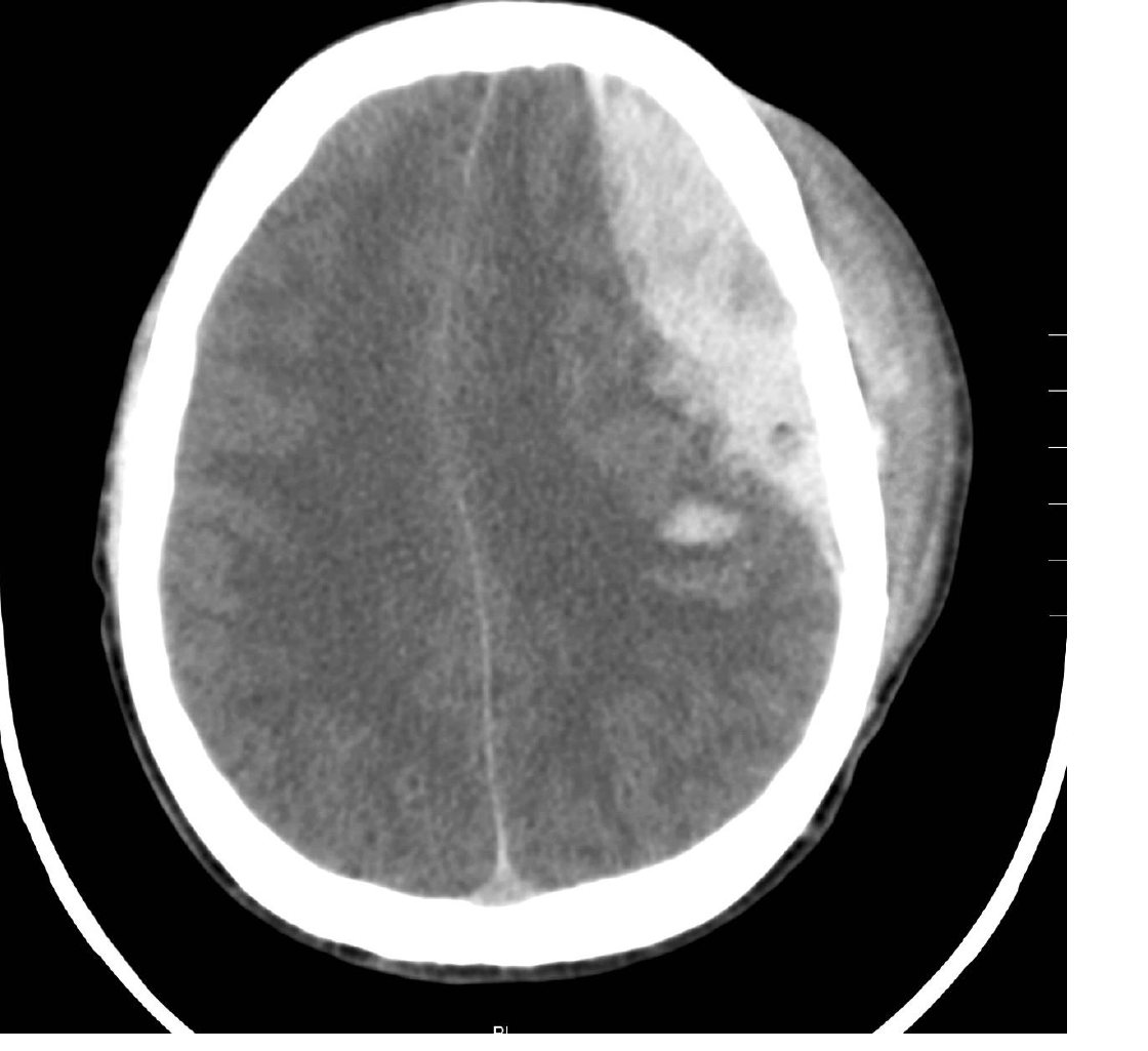 CT brain slice for a head injury patient.