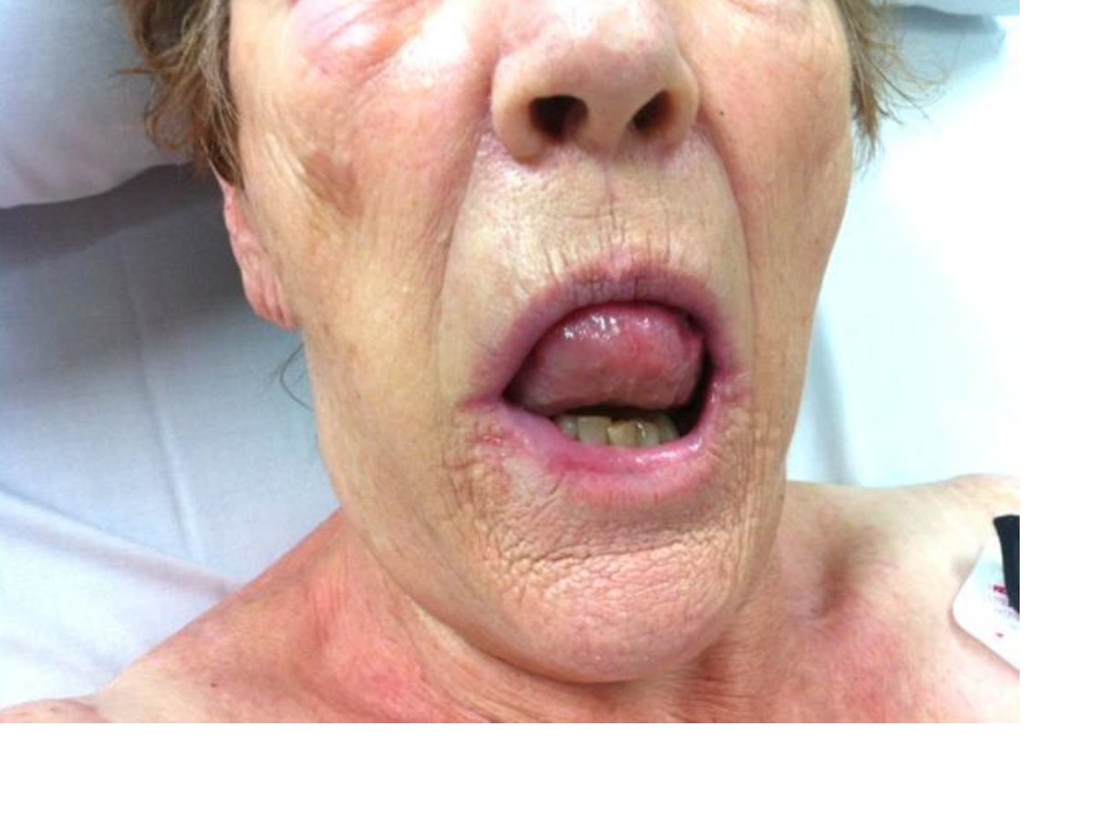 Clinical photograph for a patient with breathing difficulty after dinner.
