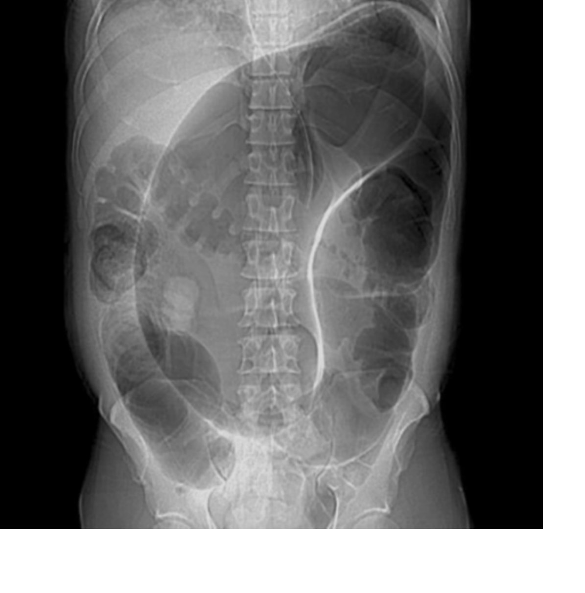 Abdominal X-ray for an elderly patient with abdominal pain.