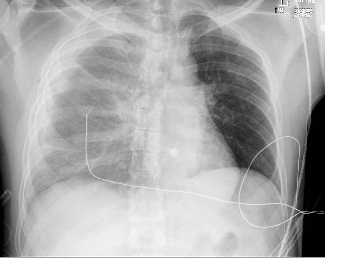 Chest X-ray after a right-sided chest stab wound.