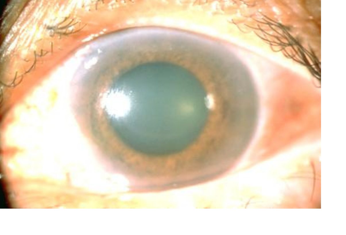 Clinical eye photograph for a painful eye presentation.