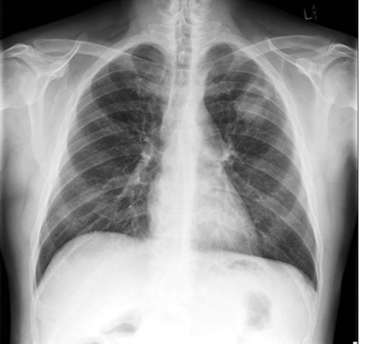Chest X-ray for a patient with two weeks of cough.