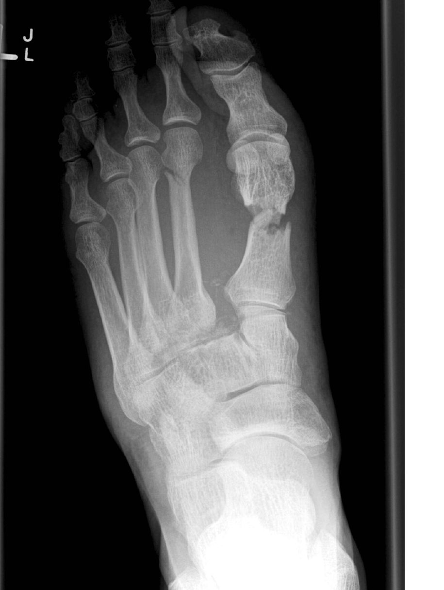 Foot X-ray after a fall from a ladder.
