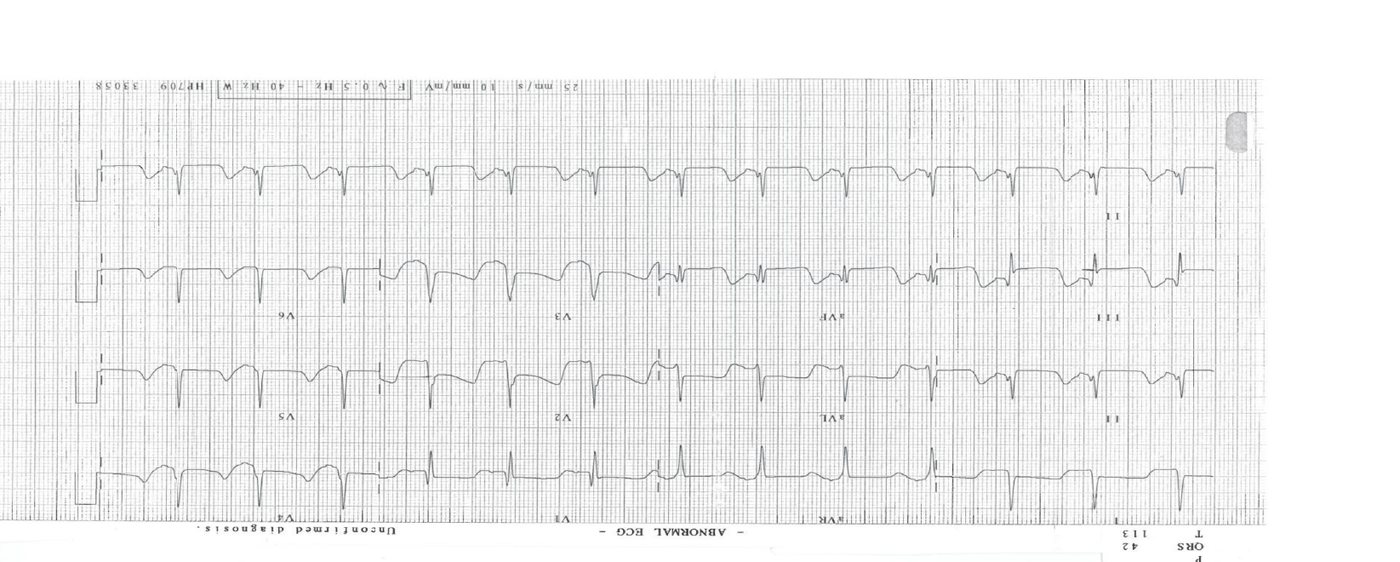 ECG for a chest pain patient with hypotension.