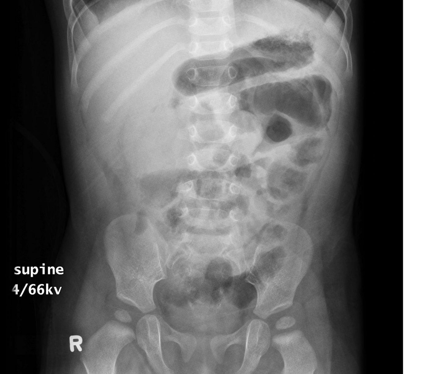 Abdominal X-ray for a child with abdominal pain.