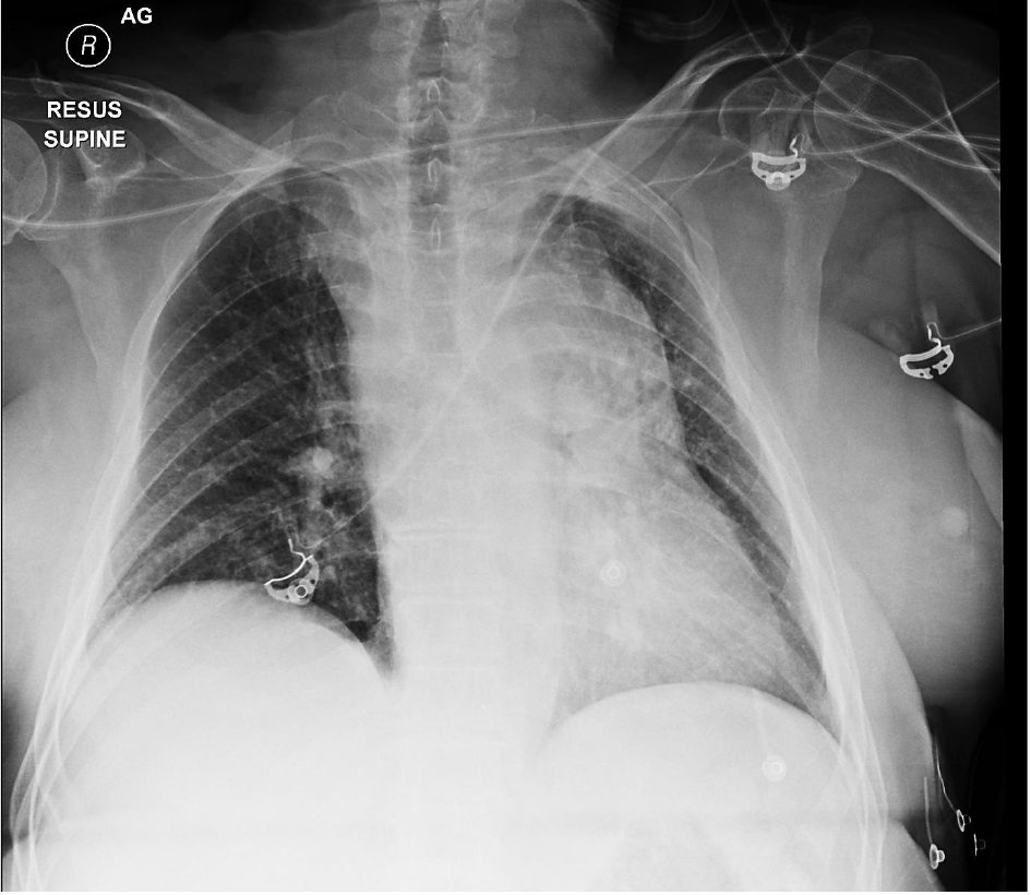 Supine chest X-ray after major trauma.