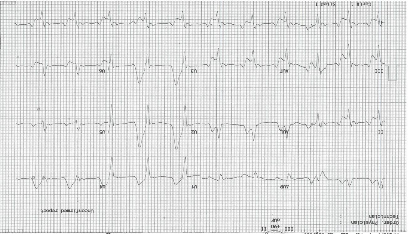 ECG for a patient with severe chest pain.