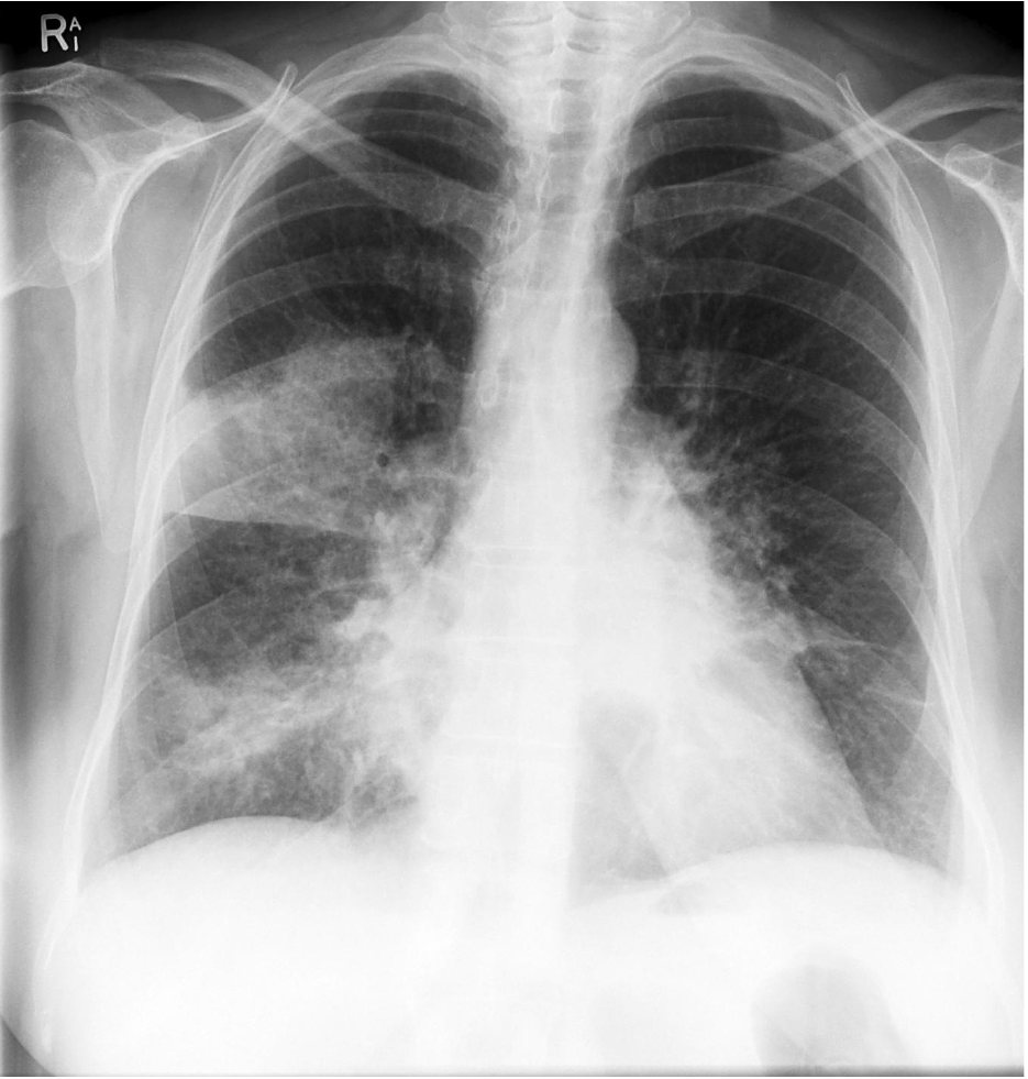 Chest X-ray for a patient with shortness of breath and cough.