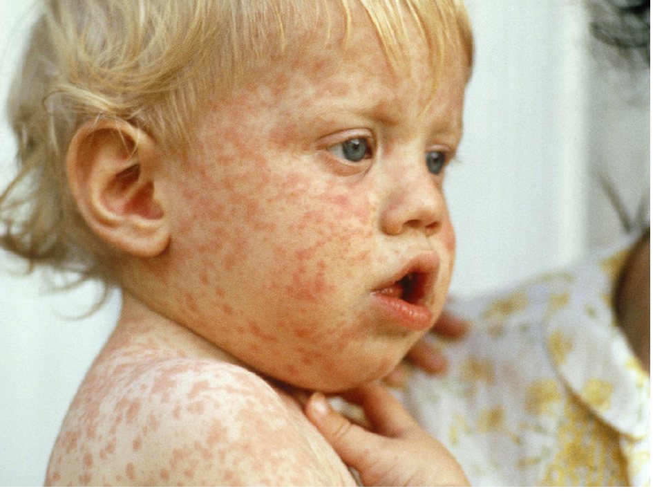 Clinical photograph of an 18-month-old child with a rash