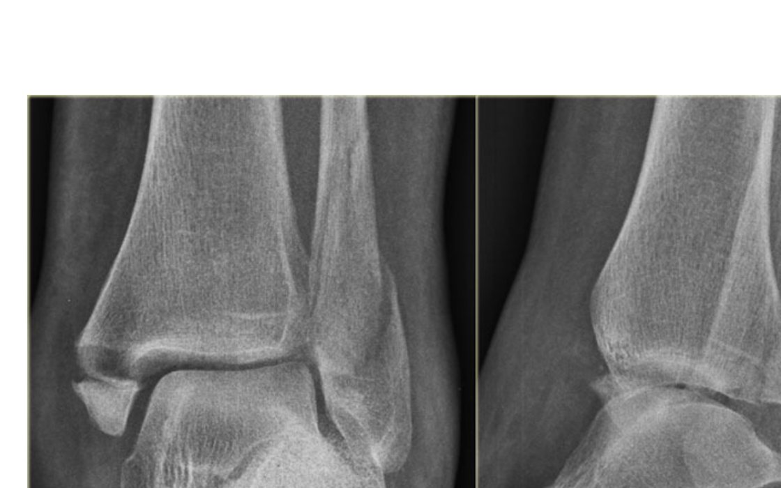 Ankle X-rays for a 57-year-old woman after a fall