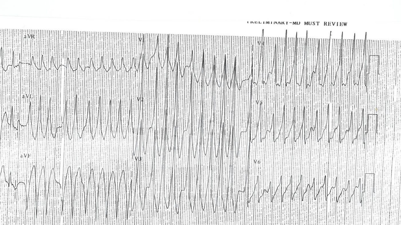 ECG for a 30-year-old man with palpitations and hypotension