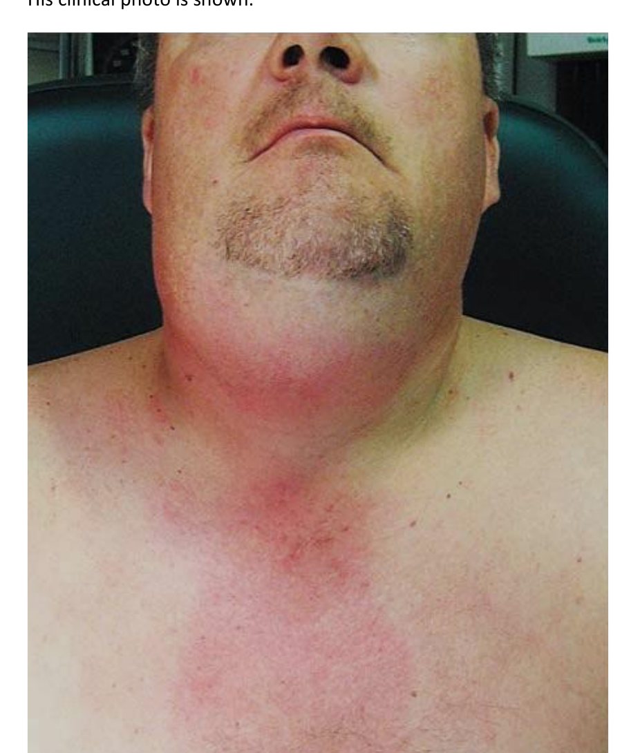 Clinical photograph for a man with pain and swelling under the jaw