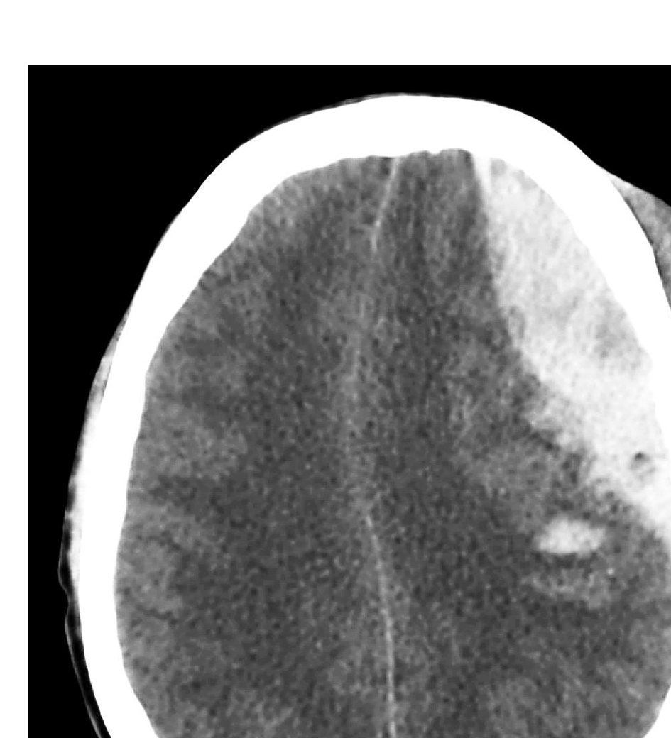 CT head image for a 25-year-old man after assault