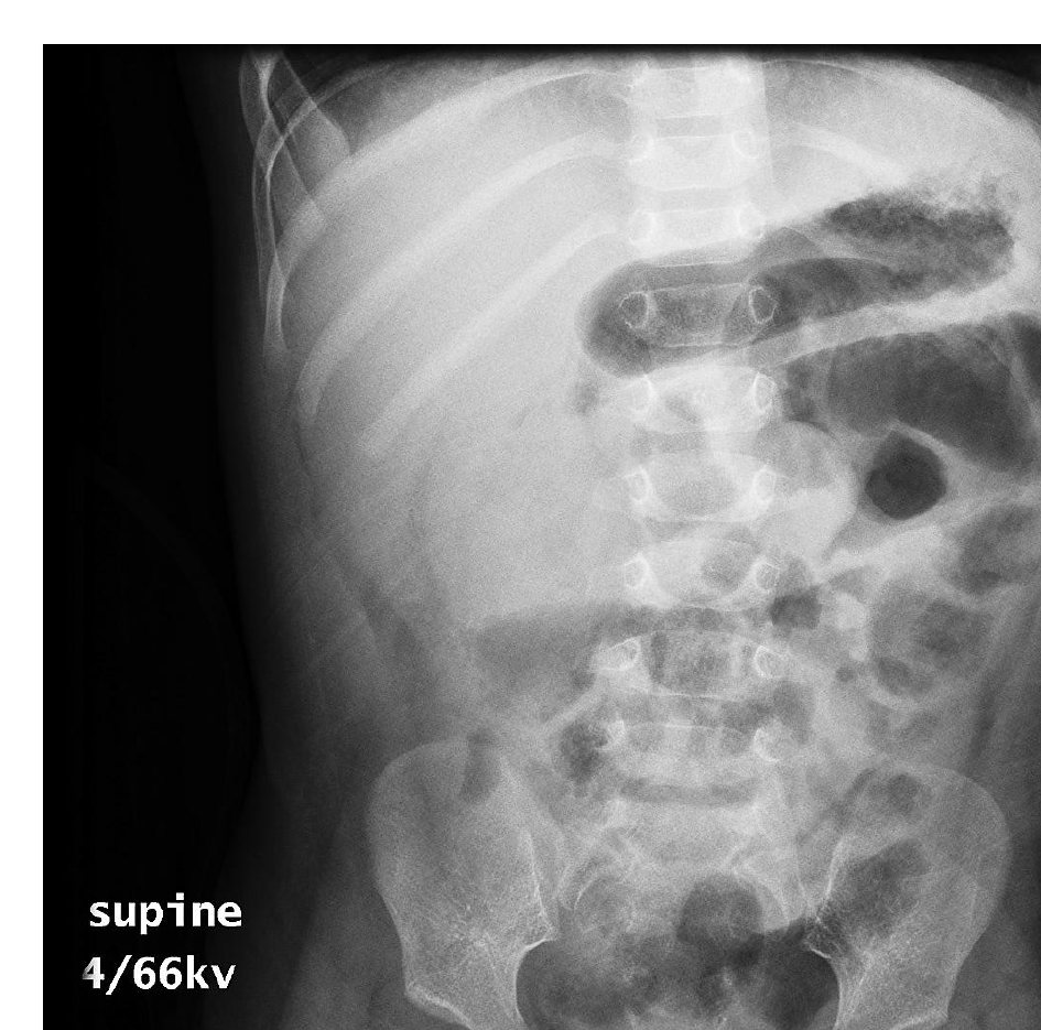 Abdominal X-ray for an 18-month-old with vomiting and abdominal distension