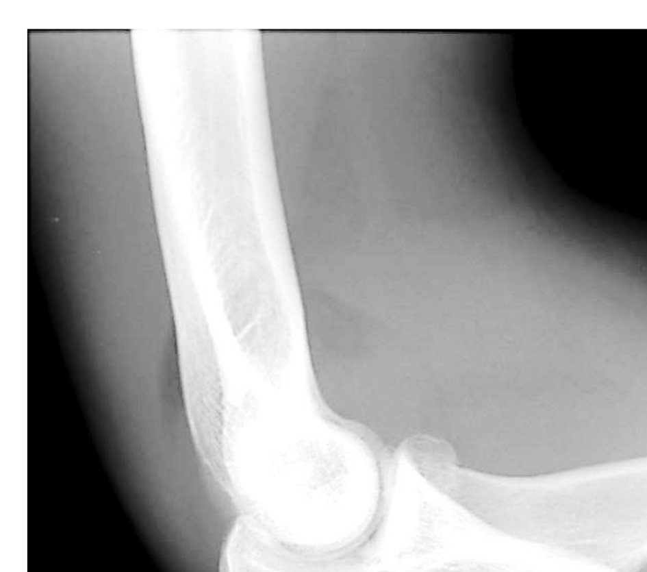 Elbow X-ray for a painful elbow after a fall