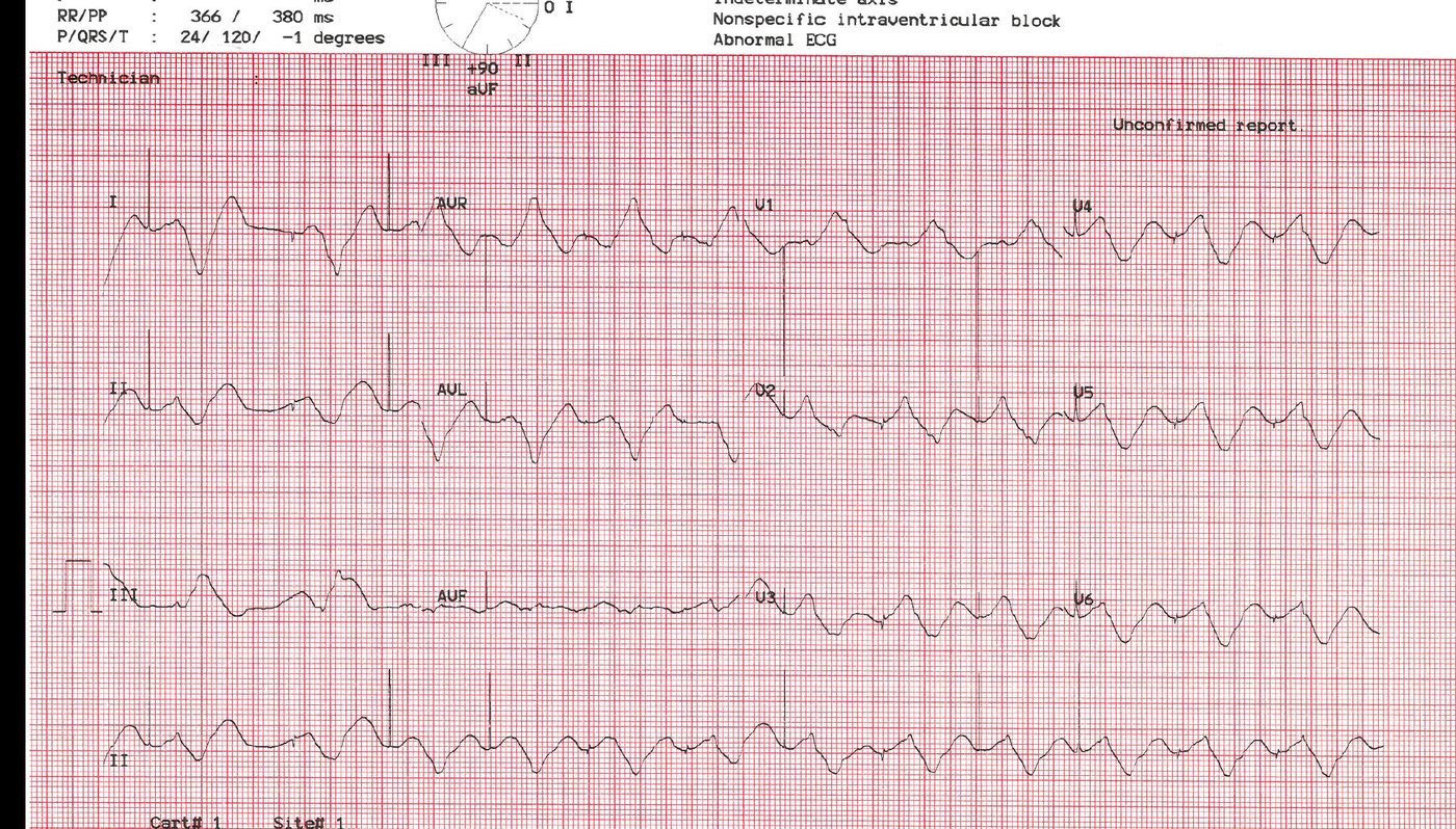 ECG for a patient with malaise and syncope