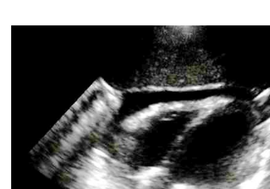 FAST ultrasound image in penetrating chest trauma