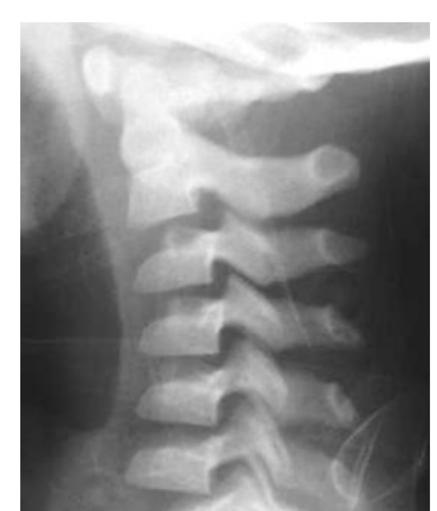 Paediatric lateral cervical spine X-ray after head injury