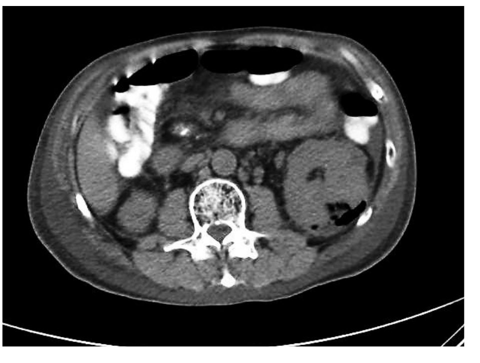 CT abdomen for a diabetic patient with flank pain and fever