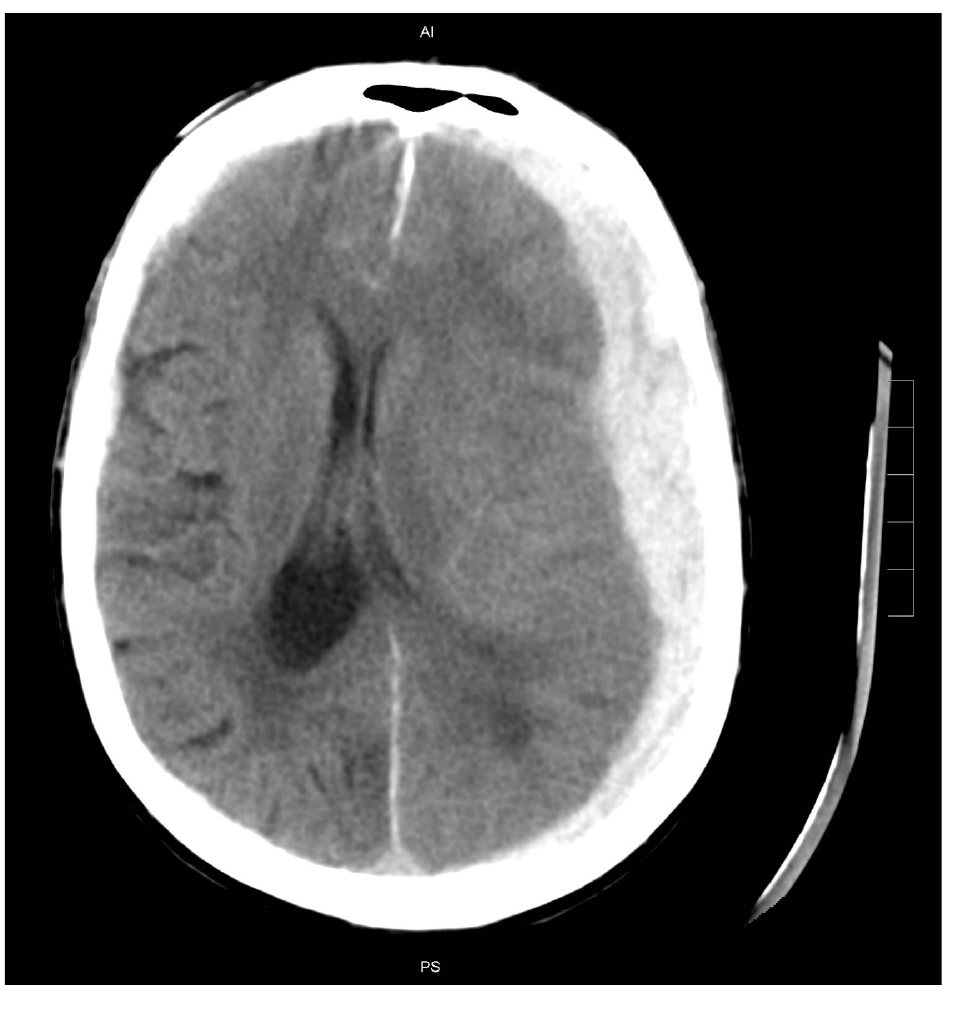 CT head slice after high-speed motor vehicle crash