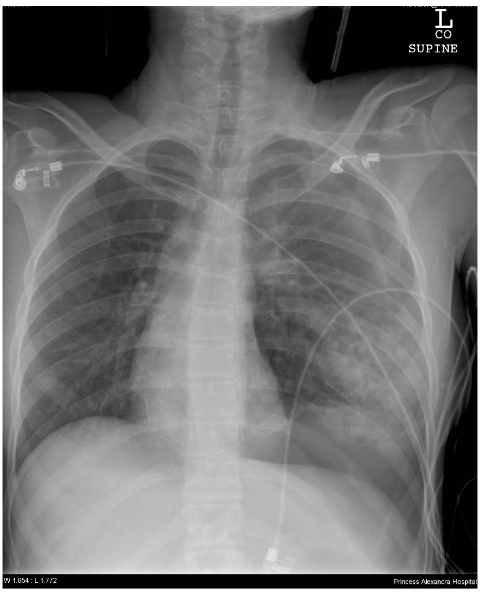 Supine chest X-ray after high-speed motor vehicle crash