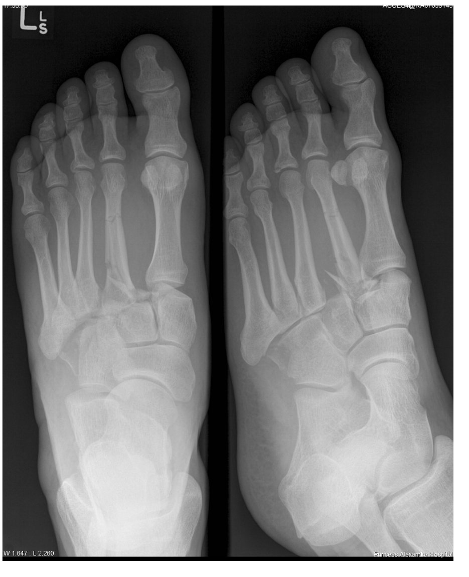 Foot X-rays after a fall from height