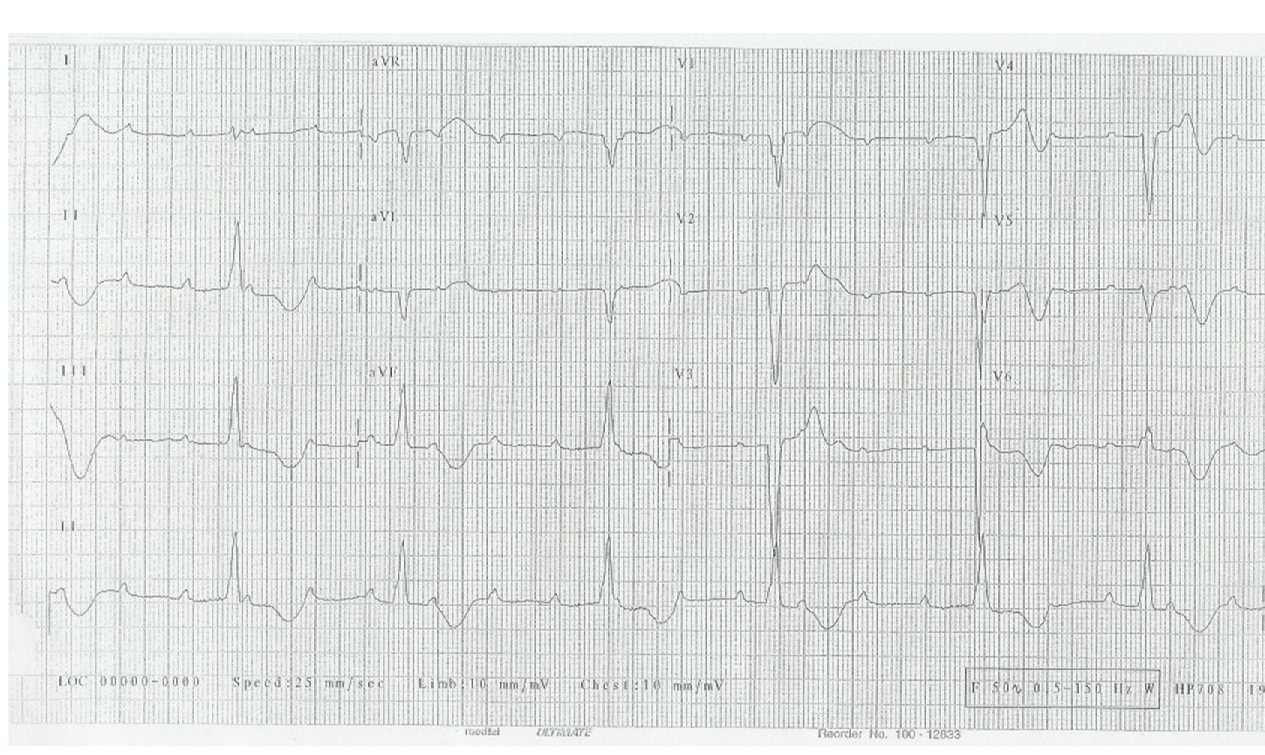 ECG for a 70-year-old man after syncope