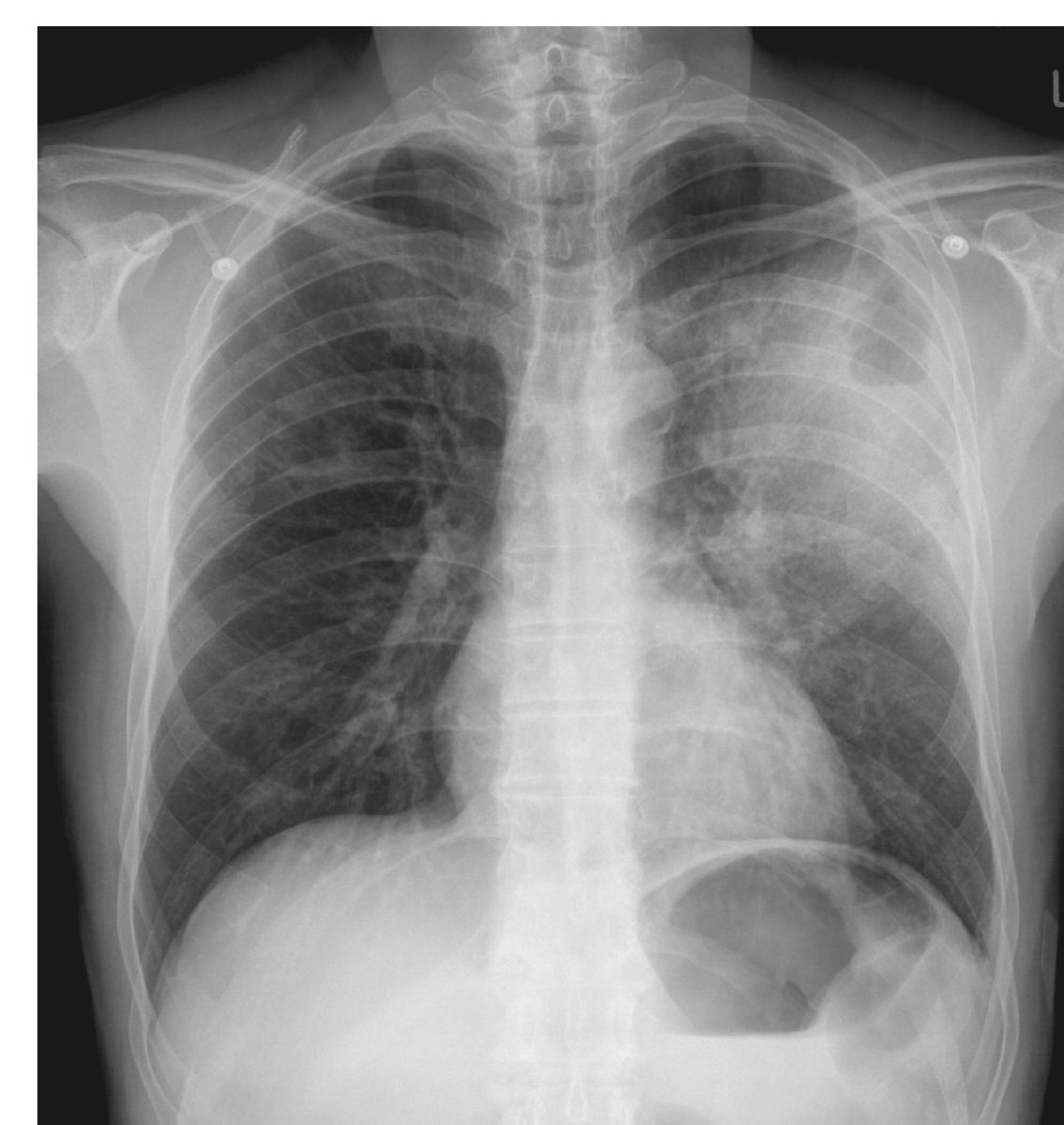 Chest X-ray for a 65-year-old man with shortness of breath