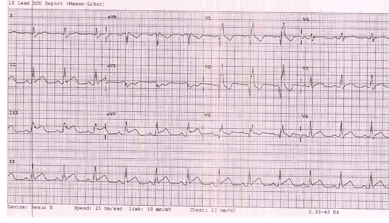 ECG for a woman with central chest pain in a rural ED