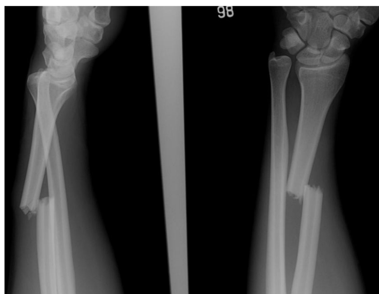 Forearm X-rays after a fall onto the right hand