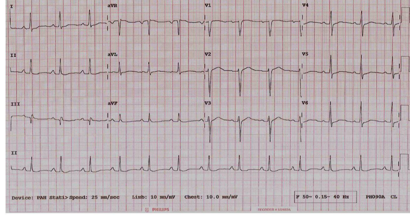 ECG for a 36-year-old man after citalopram overdose